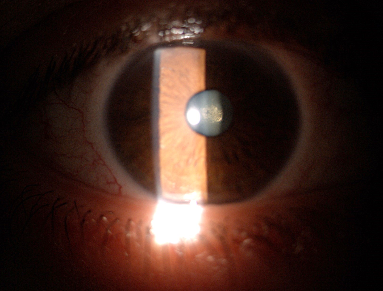 CATARATA SUBCAPSULAR POSTERIOR (2 FOTOS)