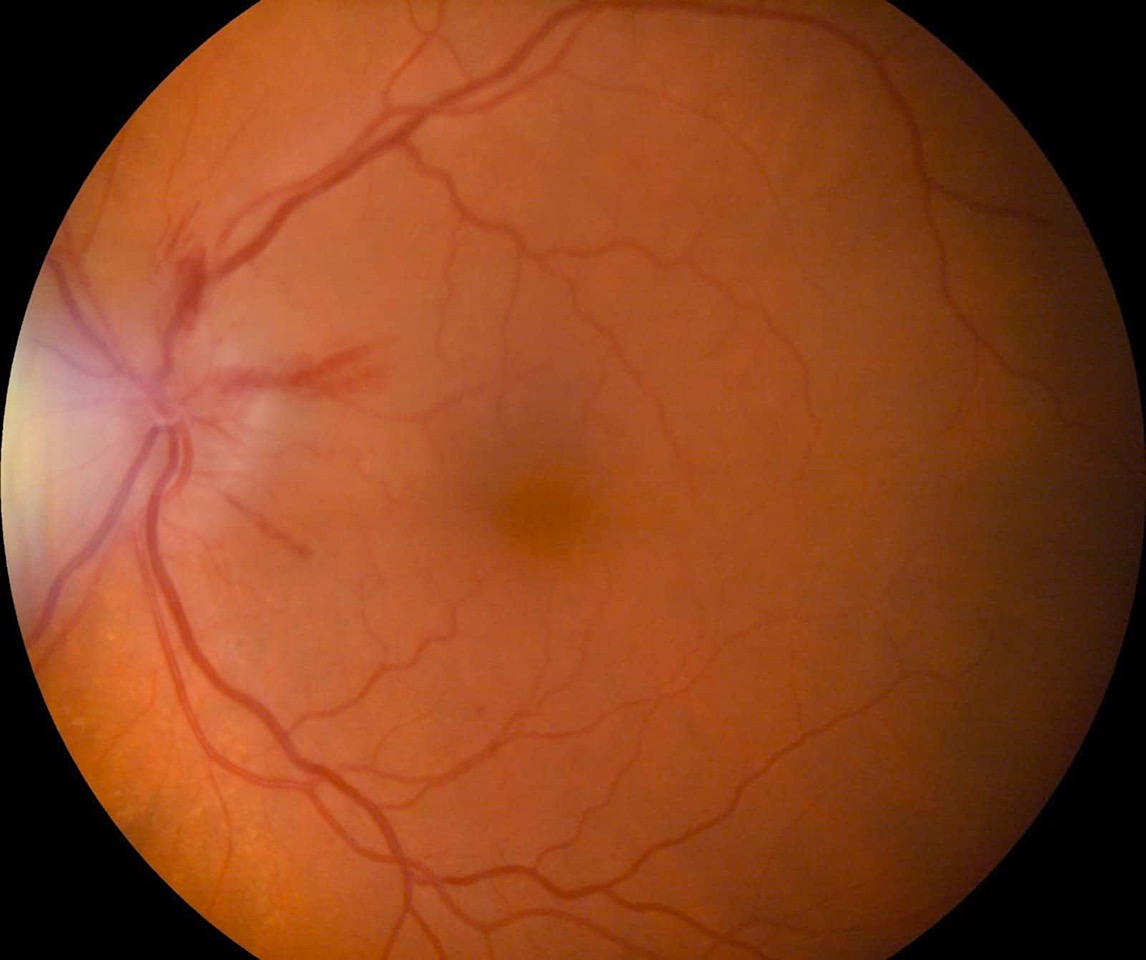 NEUROPATIA OPTICA ISQUEMICA