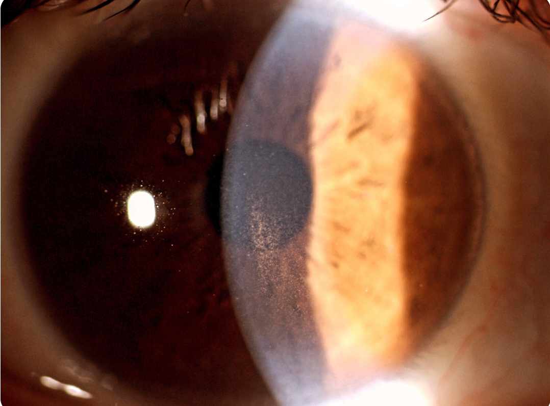 SINDROME DE DISPERSION PIGMENTARIA