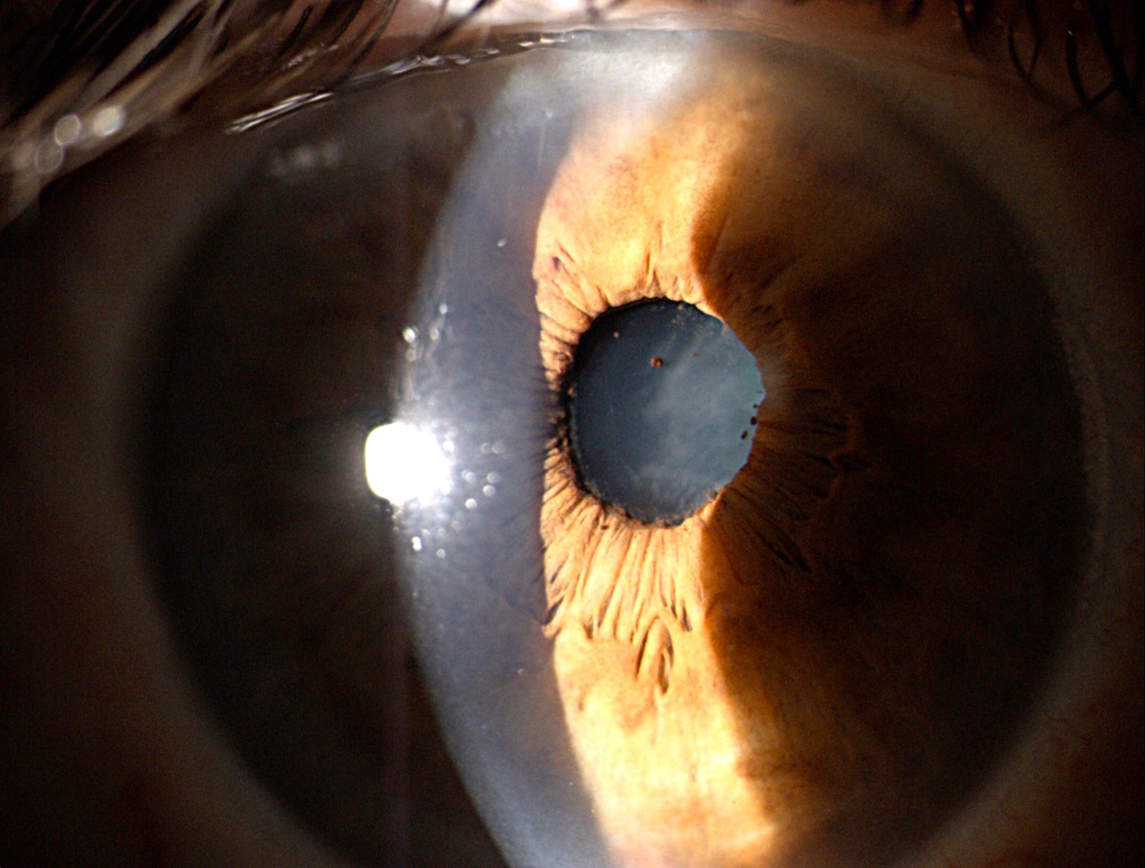 UVEITIS
