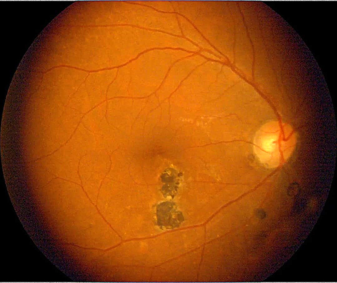 TOXOPLASMOSIS
