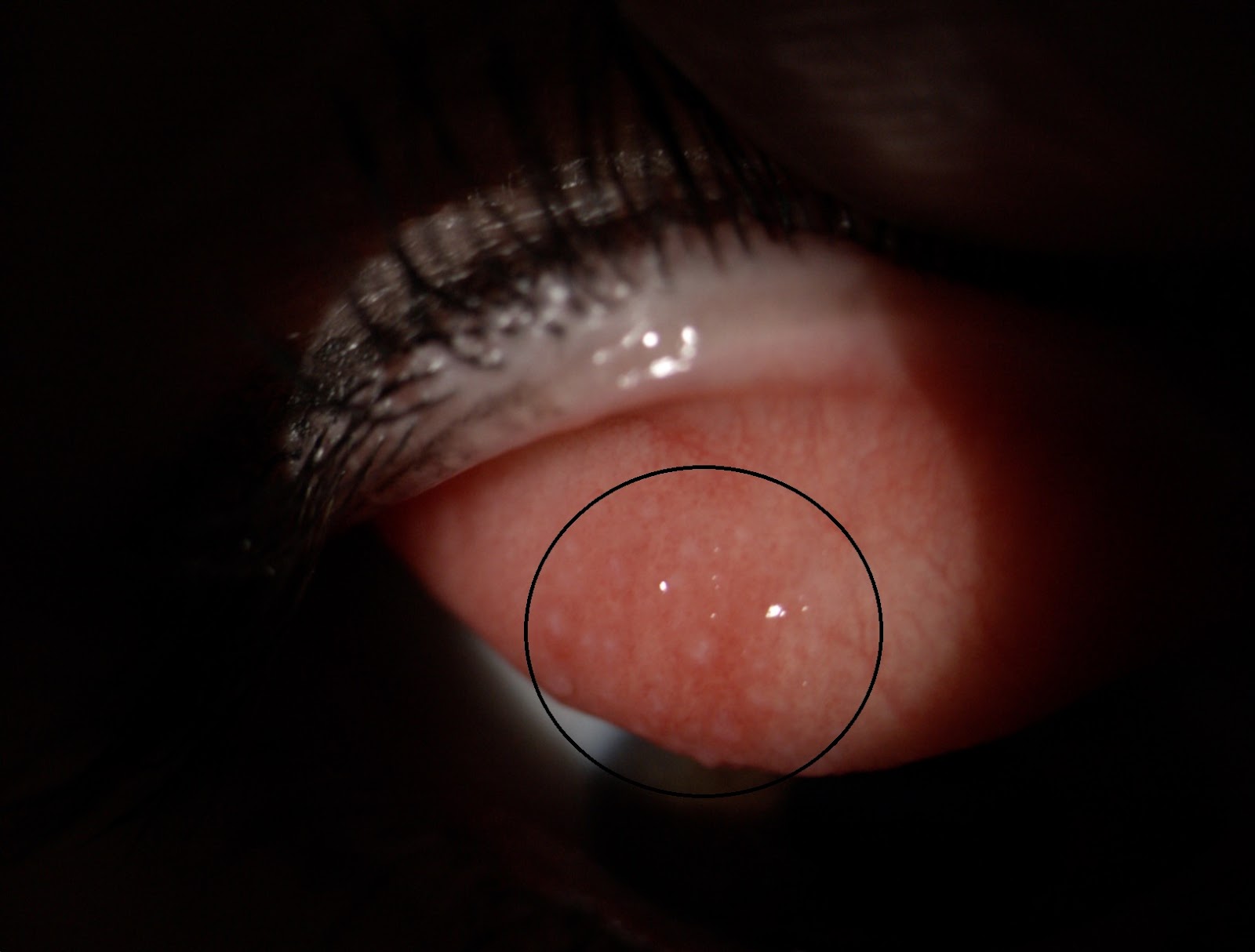 CONJUNTIVITIS PAPILAR GIGANTE