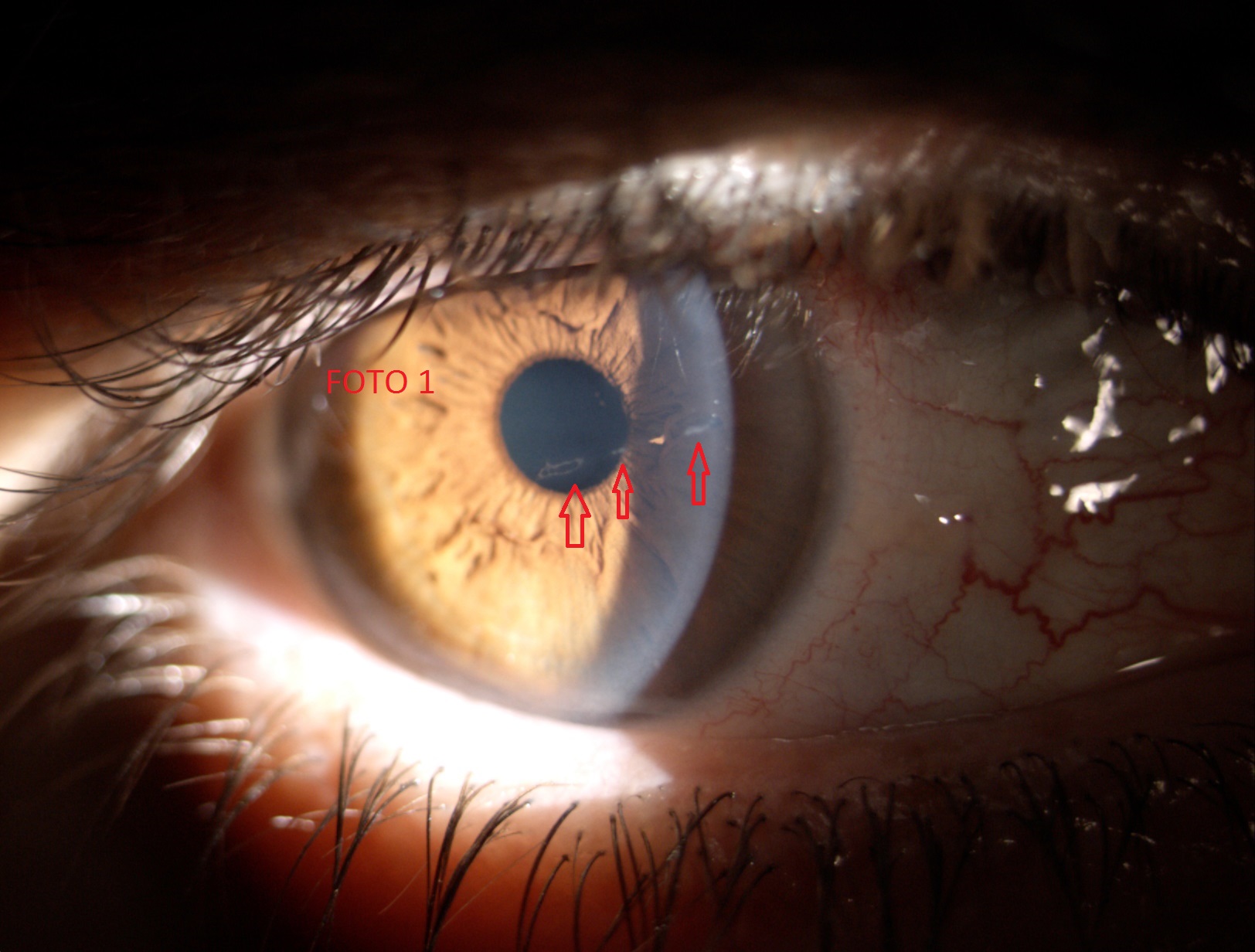 ARAÑAZO, ABRASION CORNEAL (4 FOTOS)