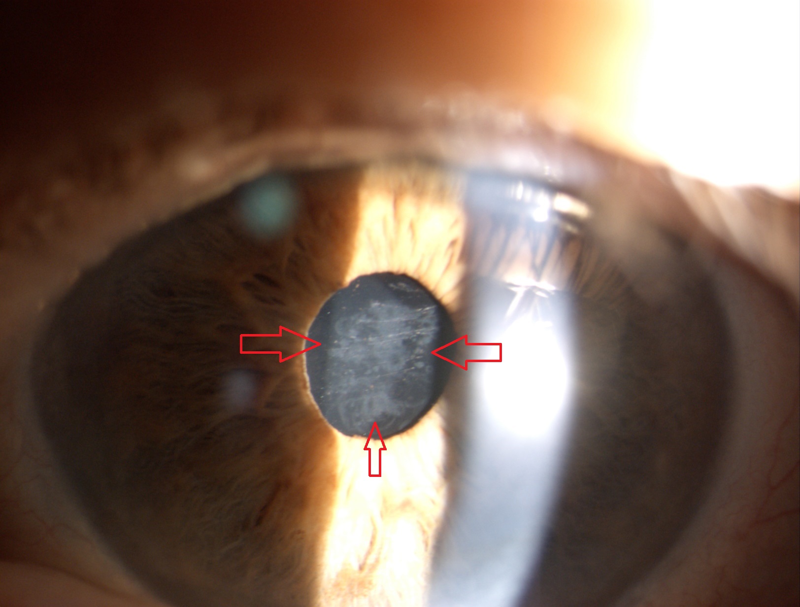 LIO (lente intraocular) SUCIA