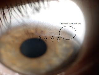 LESION EPITELIAL ARQUEADA SUPERIOR LIMBICA (3 FOTOS)