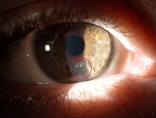 CRECIMIENTO EPITELIAL POSTERIOR A LASIK (2 FOTOS)