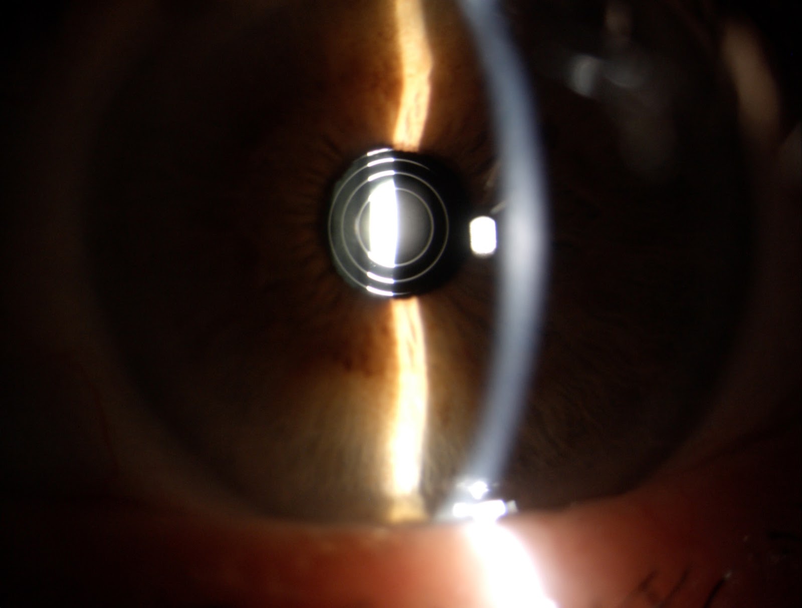 LENTE INTRAOCULAR MULTIFOCAL