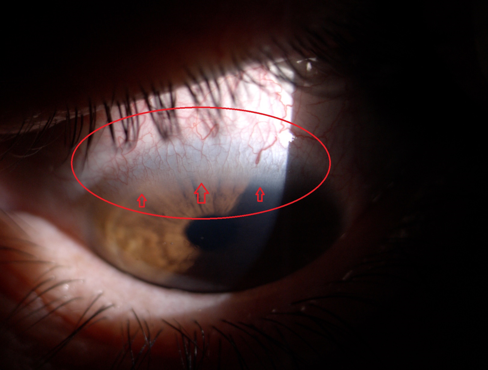 NEOVASCULARIZACION (2fotos)
